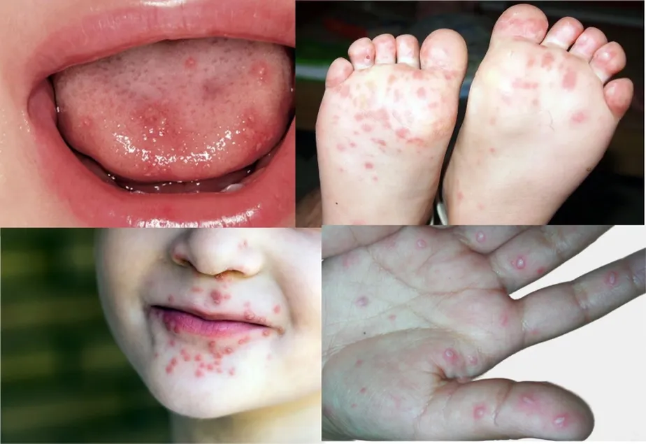 Secretaria da Saúde registra aumento de 149% nos surtos de Mão–Pé–Boca em SP este ano